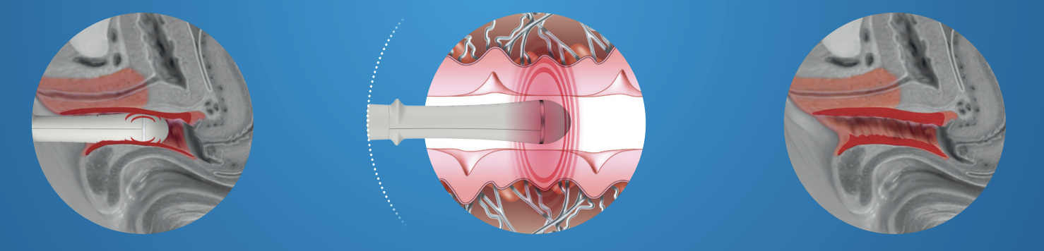 EMFEMME procedure before, during and after